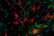 Imatge cedida pel CNIO del glioblastoma mesenquimal d'un ratolí amb les cèl·lules mare marcades en color verd i les cèl·lules diferenciades en roig