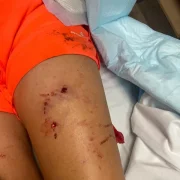 Múltiples ferides per les mossegades. - A.R.