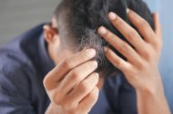 Imagen de una persona a la que se le cae el pelo.