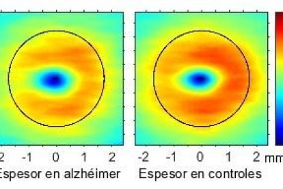 Alguns canvis a la retina poden avançar el diagnòstic de l'alzheimer