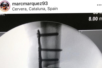 Marc Márquez amb el doctor Xavier Mir, que li va reduir la fractura d’húmer amb 12 claus.