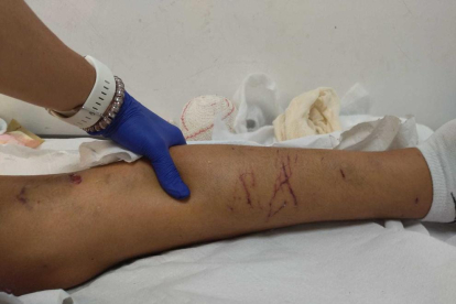 Una de les cames del jove que va ser atacat pel gos.