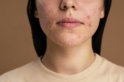 Consejos para cuidar tu piel acneica.