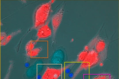 Imagen de células T (en azul brillante) que destruyen células de melanoma ocular uveal (en rojo) después del tratamiento con tebentafusp.