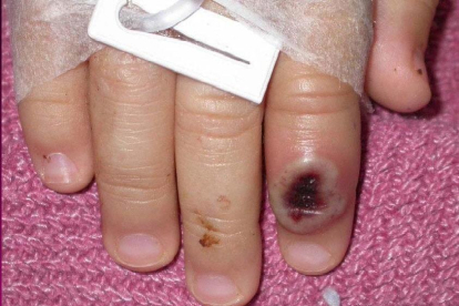 Fotografía de archivo del Centro Estadounidense de Control de las Enfermedades (CDC) en la que se aprecia el dedo de un niño infectado por la llamada 