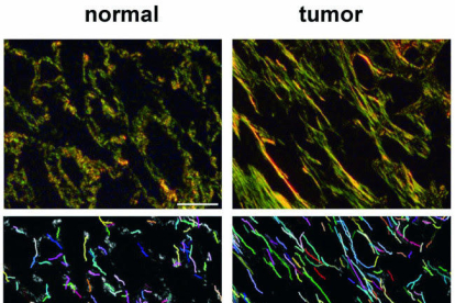Els investigadors han desenvolupat i validat una nova tècnica per analitzar quantitativament les fibres de col·lagen en mostres de teixits de pacients amb càncer de pulmó de cèl·lules no petites.