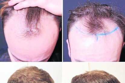 Un especialista de Sommedics insereix fol·licles a un pacient.