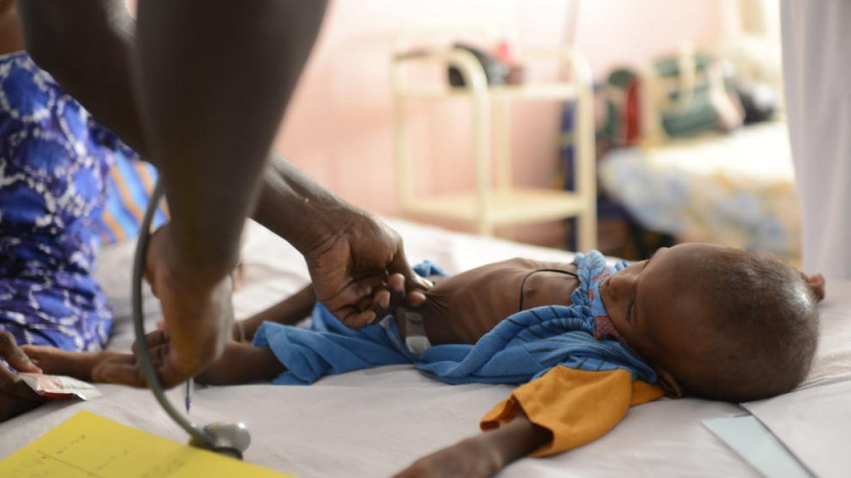 Imagen de un niño desnutrido en un hospital de Senegal.