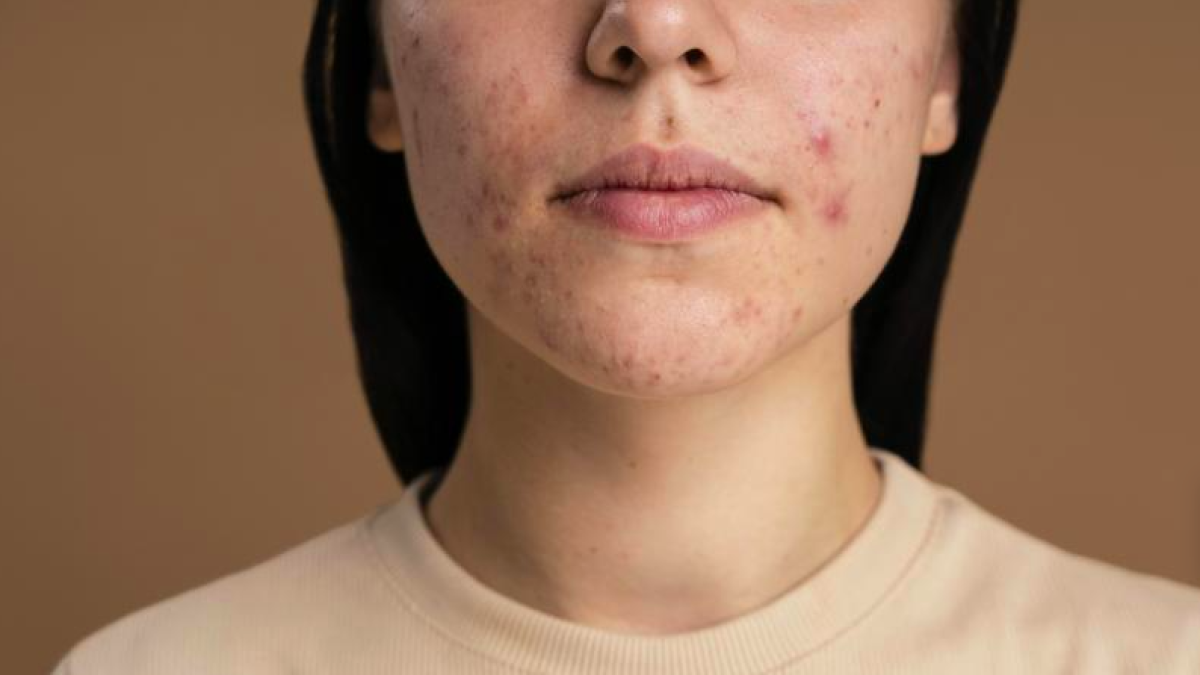 Consejos para cuidar tu piel acneica.