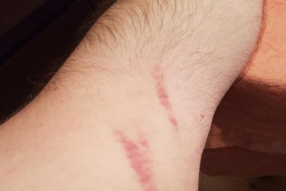 Marcas en el brazo que ha presentado como prueba el denunciante.