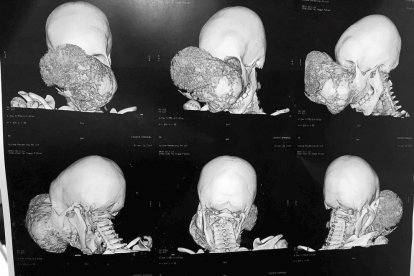 Cavadas extirpa a un niño africano uno de los mayores tumores que ha operado