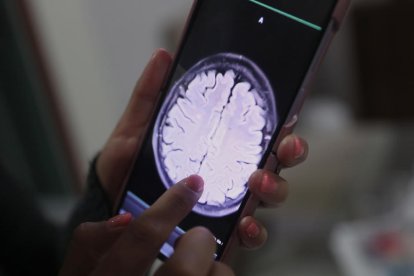 Logran que la quimioterapia penetre en el cerebro contra un tumor mortal