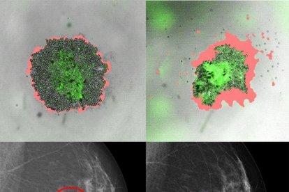 Càncer de mama: desenvolupen un mètode capaç de predir com respondran les pacients a determinats tractaments