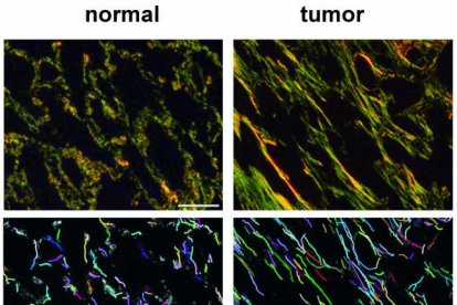 Els investigadors han desenvolupat i validat una nova tècnica per analitzar quantitativament les fibres de col·lagen en mostres de teixits de pacients amb càncer de pulmó de cèl·lules no petites.