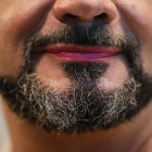 No només es trasplanta pèl per evitar la calvície, també per lluir barba