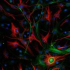 Imagen cedida por el CNIO del glioblastoma mesenquimal de un ratón con las células madre marcadas en color verde y las células diferenciadas en rojo