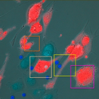 Imagen de células T (en azul brillante) que destruyen células de melanoma ocular uveal (en rojo) después del tratamiento con tebentafusp.