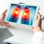 El cáncer de pulmon afectó a casi 30.000 personas en el 2021.