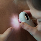 Cada mes es diagnostiquen melanomes a 300 persones a Espanya.