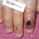Fotografía de archivo del Centro Estadounidense de Control de las Enfermedades (CDC) en la que se aprecia el dedo de un niño infectado por la llamada ""viruela de mono""