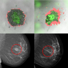 Càncer de mama: desenvolupen un mètode capaç de predir com respondran les pacients a determinats tractaments
