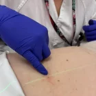 La tinta s’acaba reabsorbint després del tractament. - GSS