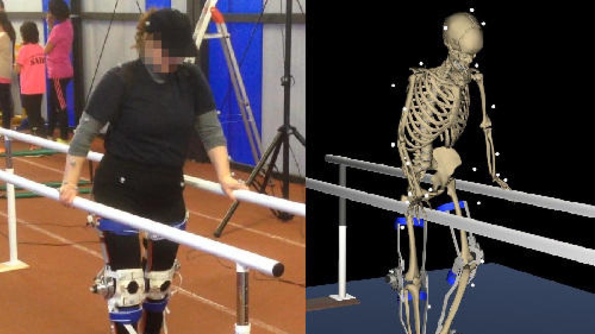 Paciente con hemiparesia infantil realizando pruebas de marcha en la UPC.