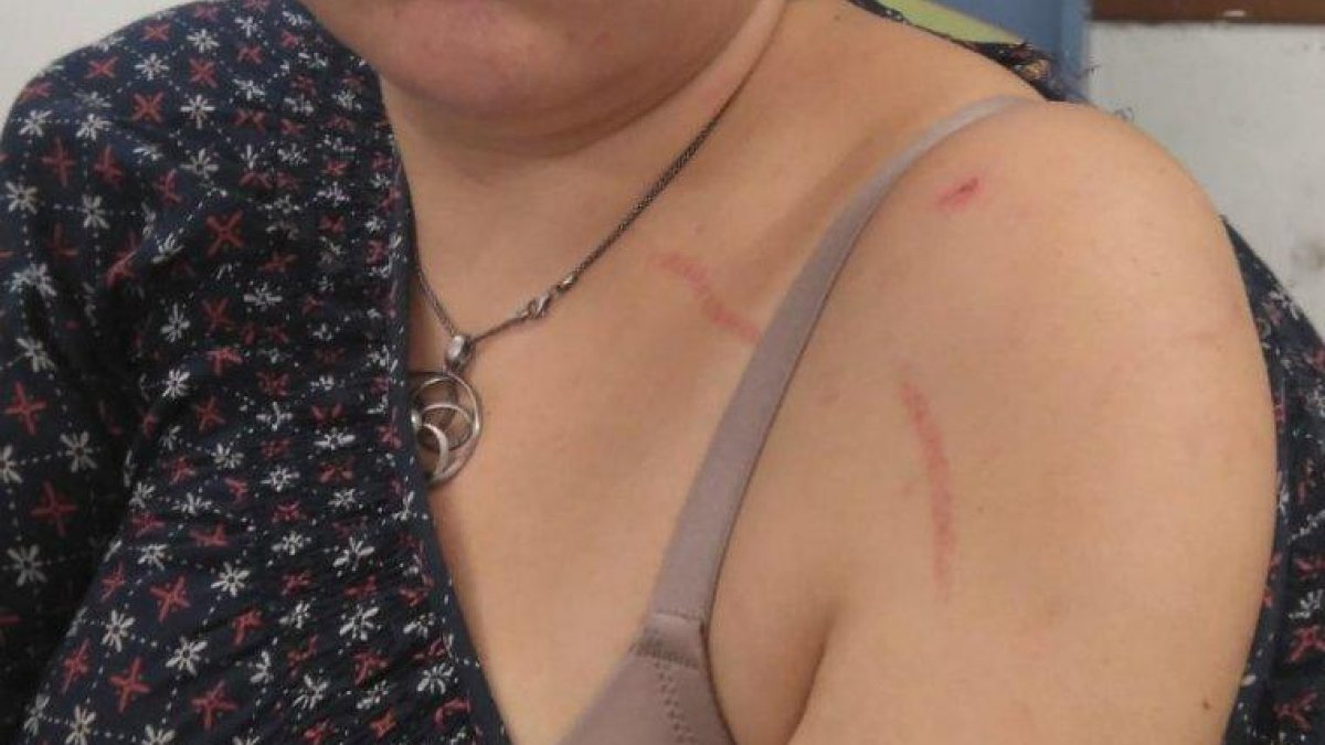 Els agressors li van causar esgarrapades a l'espatlla i l'avantbraç.