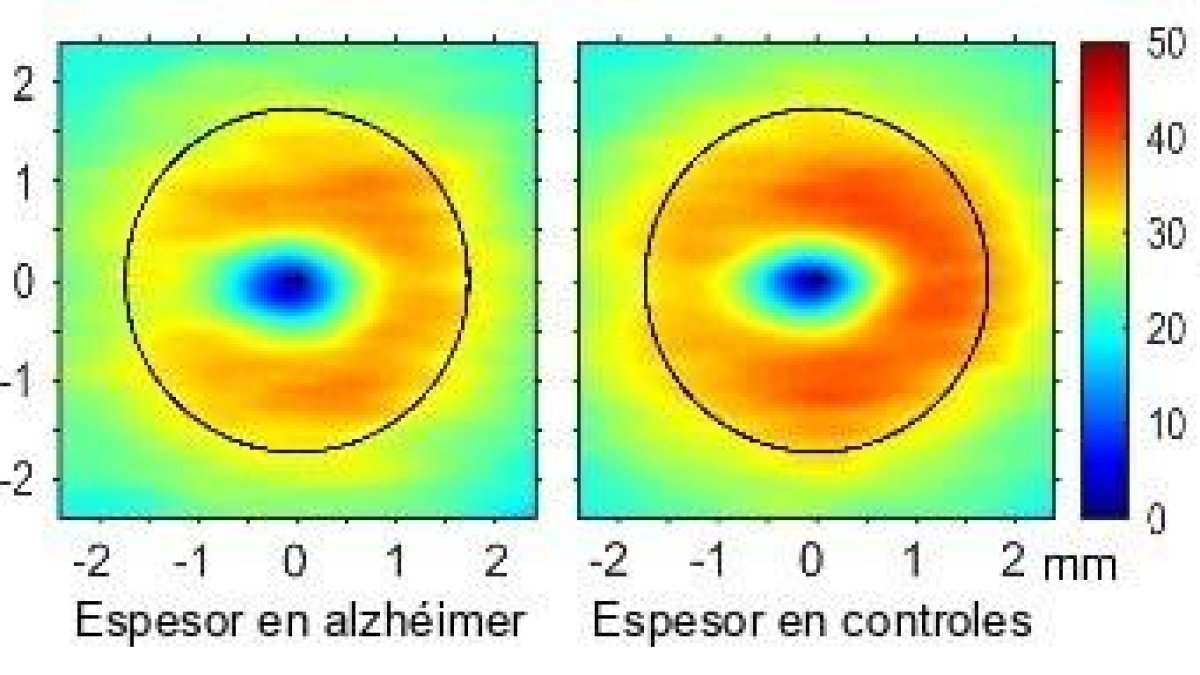 Alguns canvis a la retina poden avançar el diagnòstic de l'alzheimer