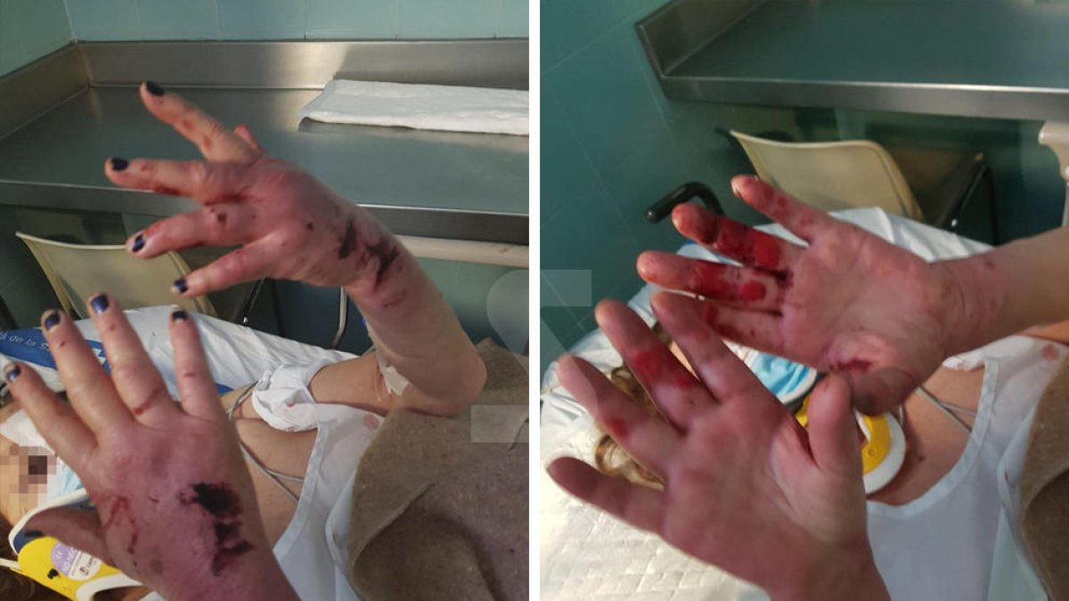 Part superior de les mans unflades pels cops de les pedres || Ferides a la part interna de les mans d'agafar-se al cable