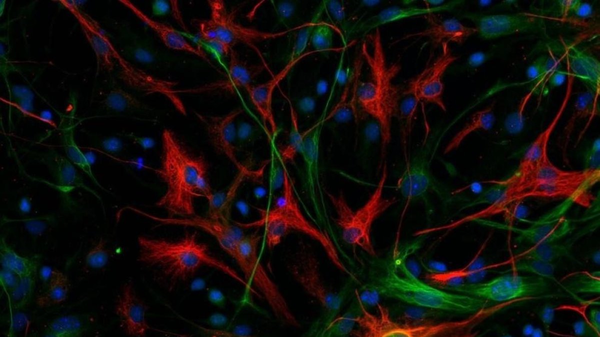 Imatge cedida pel CNIO del glioblastoma mesenquimal d'un ratolí amb les cèl·lules mare marcades en color verd i les cèl·lules diferenciades en roig