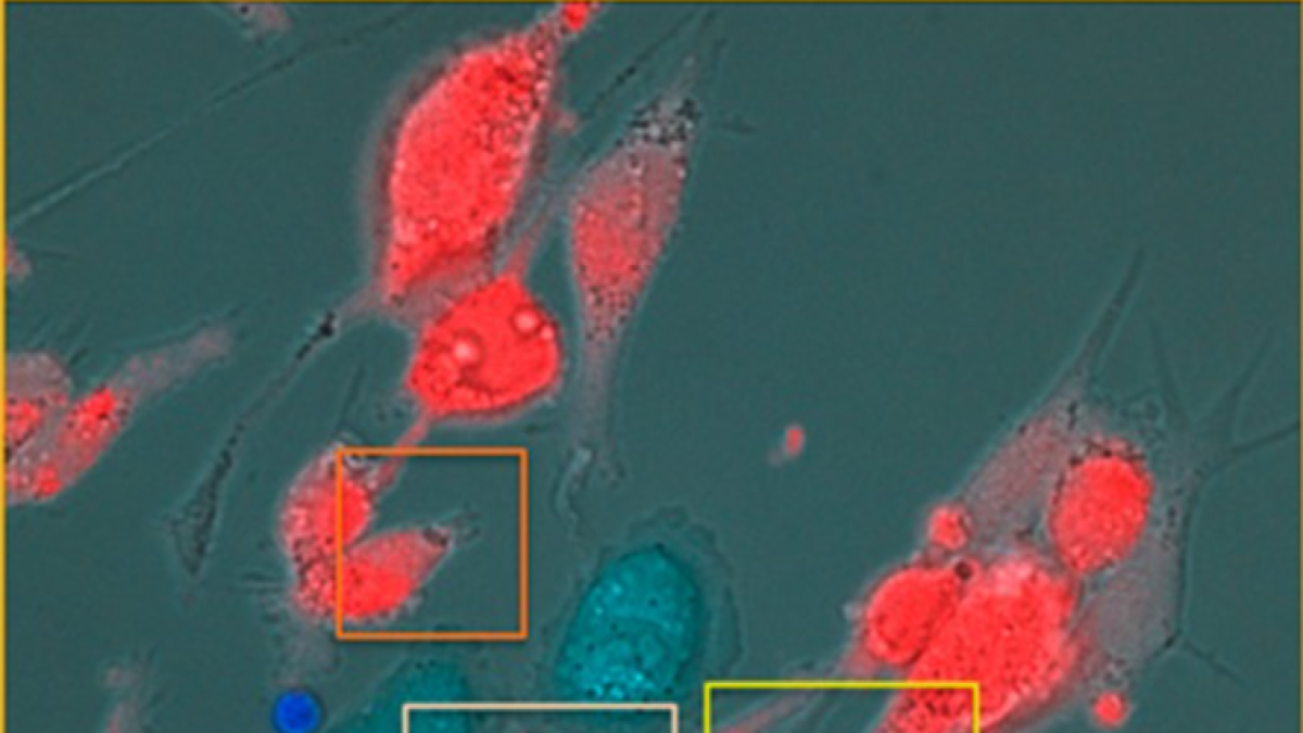 Imagen de células T (en azul brillante) que destruyen células de melanoma ocular uveal (en rojo) después del tratamiento con tebentafusp.