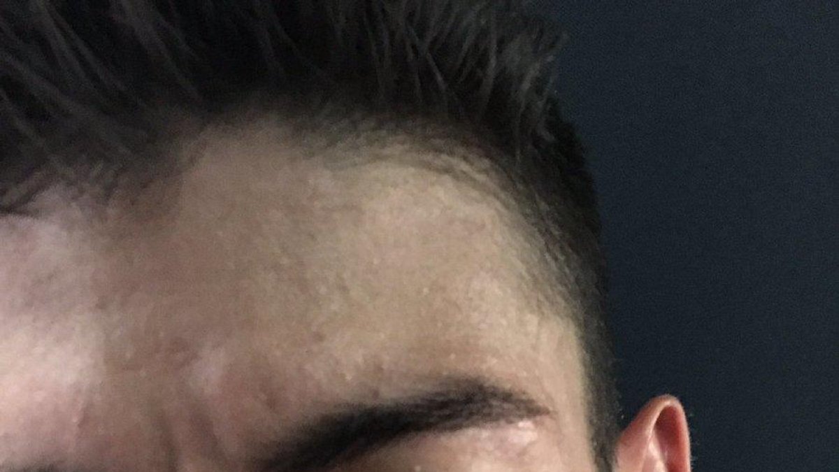 Bernat Font va publicar aquesta foto del seu rostre ferit.