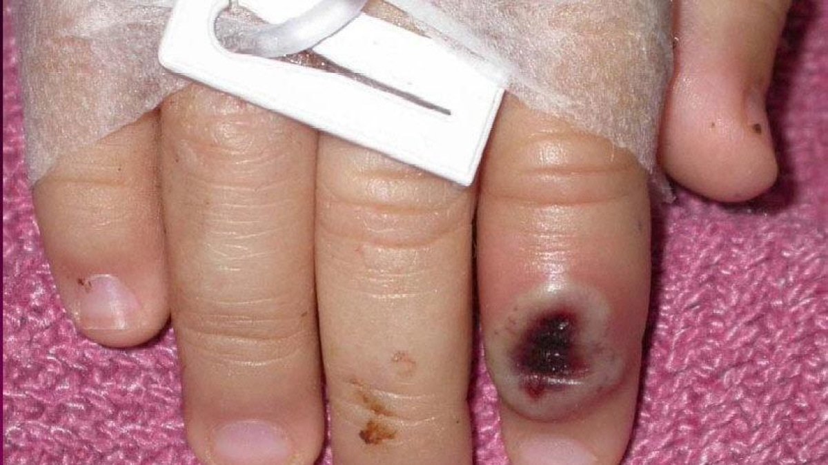 España lidera los contagios por viruela del mono en Europa, con 6.947 casos