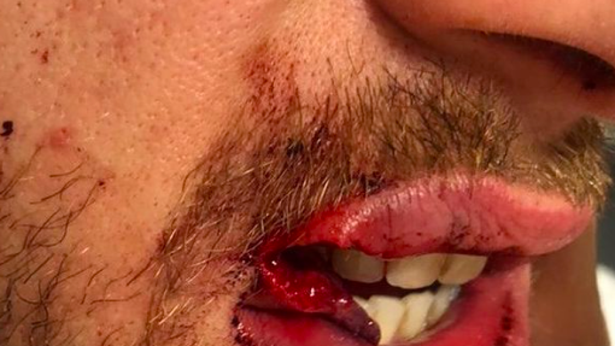 Nova agressió homòfoba: li parteixen el llavi a un jove