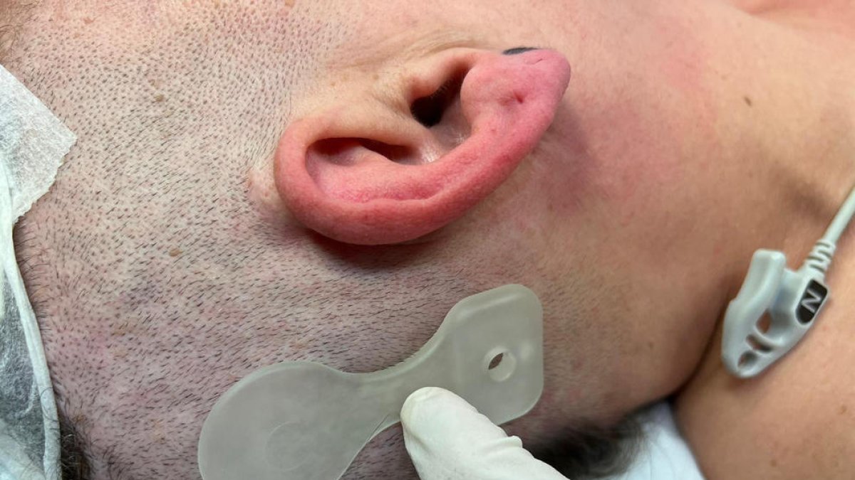 Un dels implants auditius Osia (Cochlear).