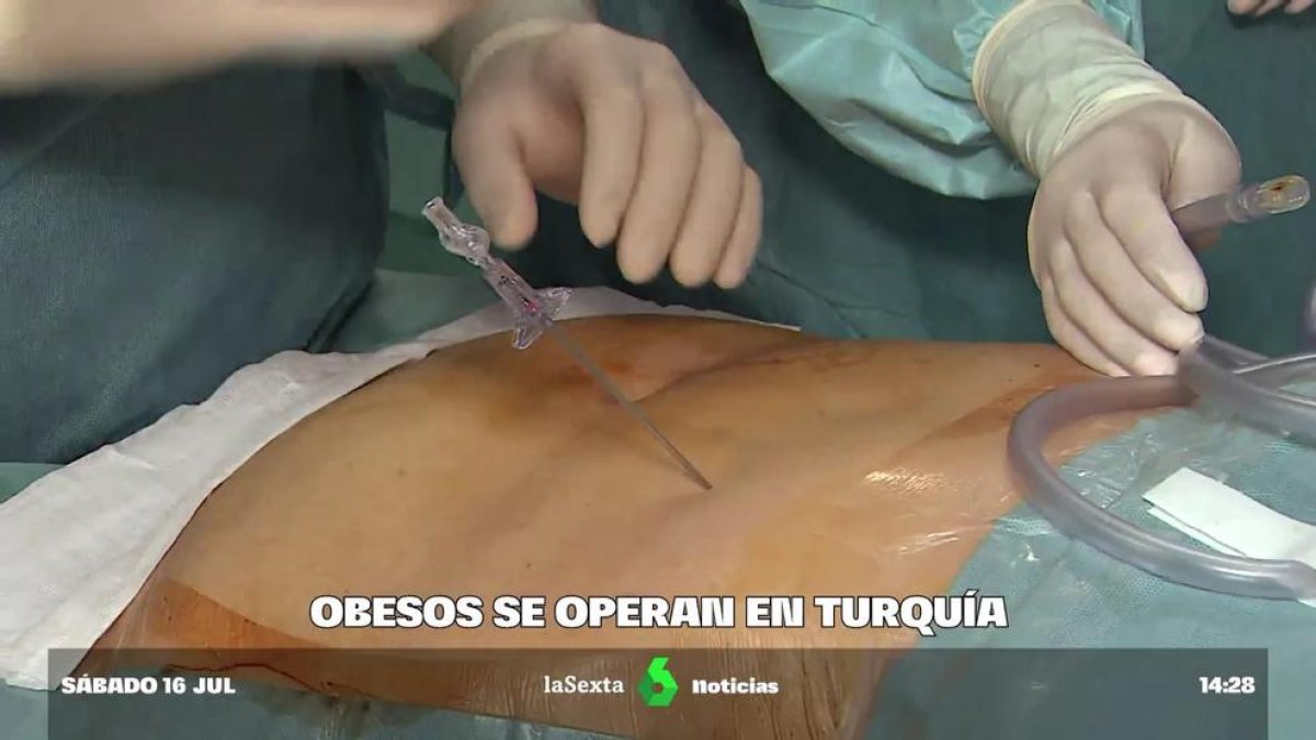 Molts espanyols van a Turquia per a retocs i cirurgia estètica.