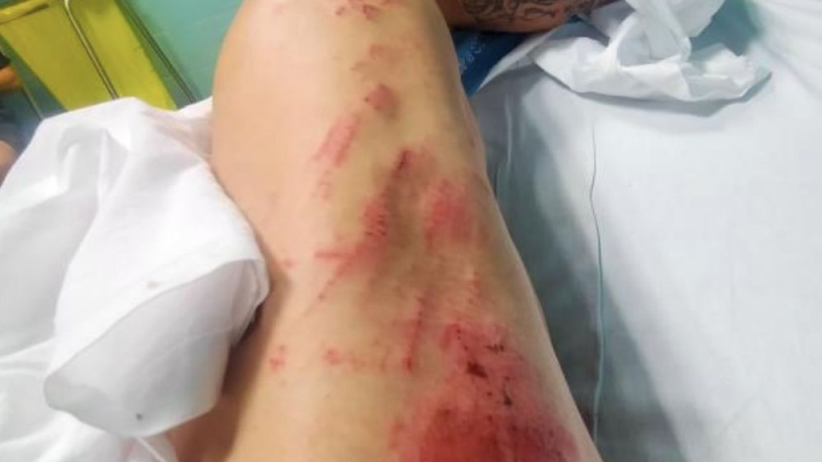 Ferides que presentava el ciclista després de ser atropellat