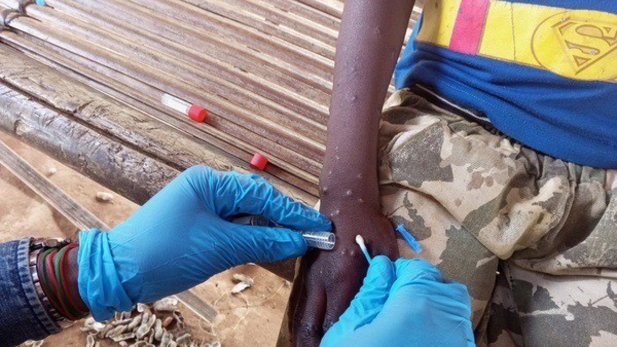 Tratamiento de mpox en el Congo.