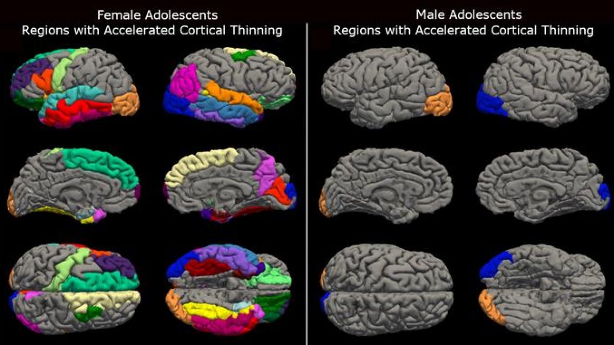 Els confinaments durant la pandèmia de Covid-19 van provocar una maduració cerebral inusualment accelerada en els adolescents que va ser més pronunciada en les dones, com es veu a l’esquerra.
