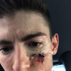 Bernat Font publicó esta foto de su rostro herido.